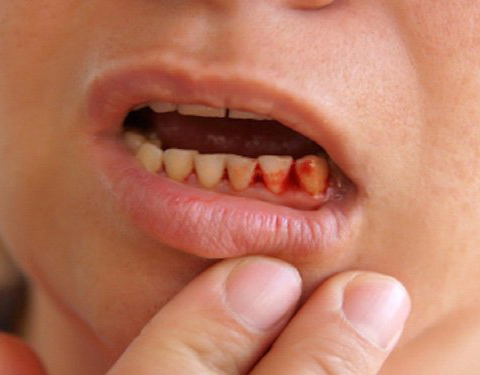 Những cách xử lý chảy máu chân răng hiệu quả tại nhà