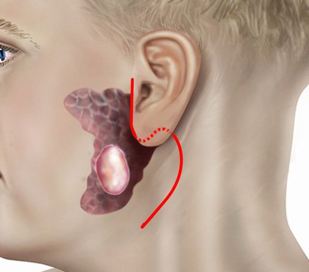 Tìm hiểu về u tuyến nước bọt mang tai