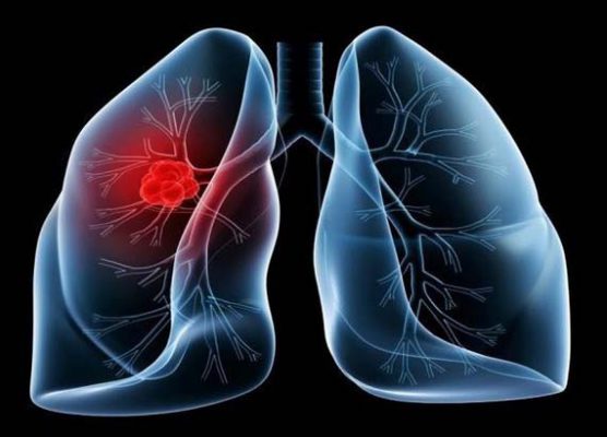 Ung thư phổi một trong những bệnh nguy hiểm